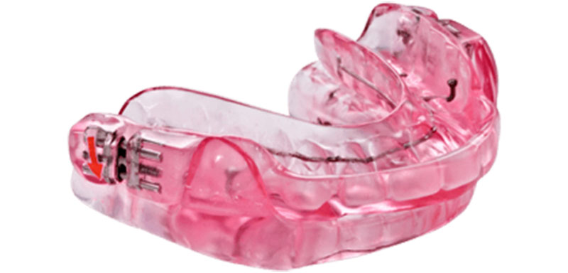 Sleep apnea oral appliance